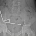 Boy hospitalised after swallowing dozens of high-powered magnets in New Zealand