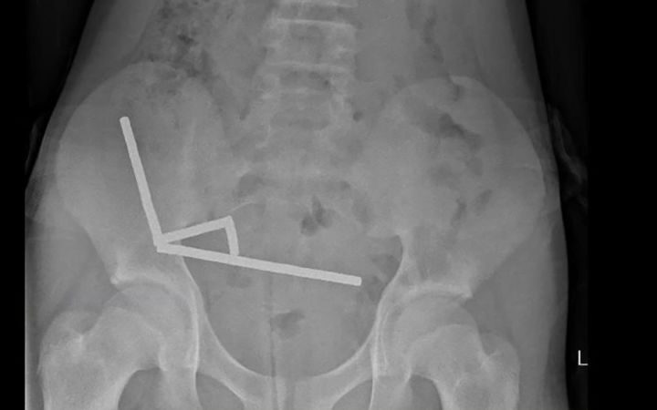 Boy hospitalised after swallowing dozens of high-powered magnets in New Zealand