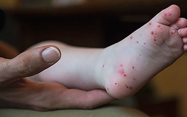 Rise in hand, foot and mouth disease cases reported in mid-Atlantic region