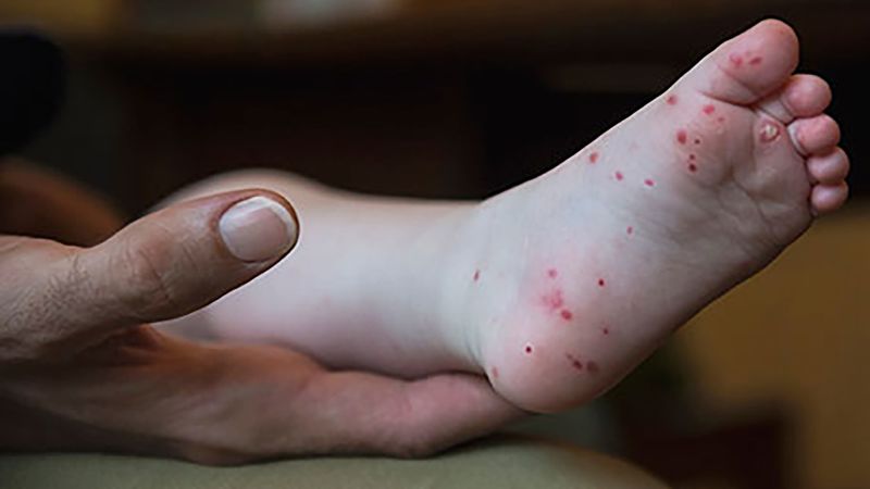 Rise in hand, foot and mouth disease cases reported in mid-Atlantic region