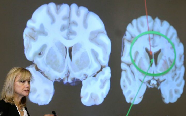 Study reveals genetic damage linked to chronic traumatic encephalopathy in athletes and veterans