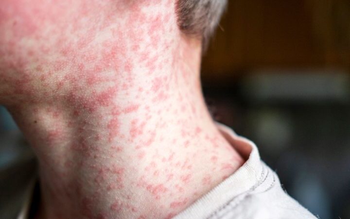 Over 2,000 measles cases reported in the US this year as outbreaks threaten elimination status