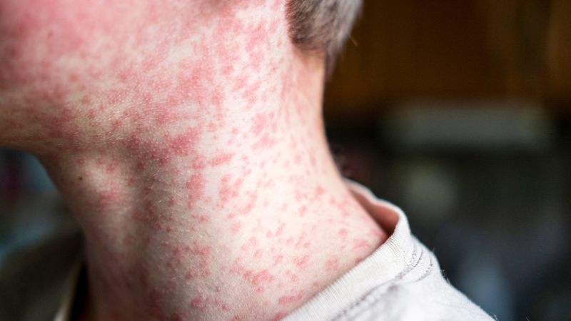 Over 2,000 measles cases reported in the US this year as outbreaks threaten elimination status
