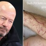 Alan Shearer shares injury update after bike accident caused by pothole