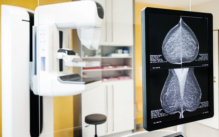 Global breast cancer cases projected to exceed 3.5 million by 2050