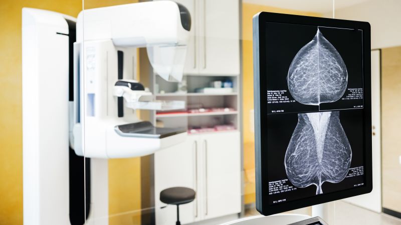Global breast cancer cases projected to exceed 3.5 million by 2050