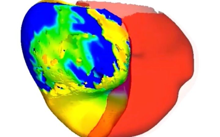 Scientists use digital twins of hearts to improve treatment for complex arrhythmias