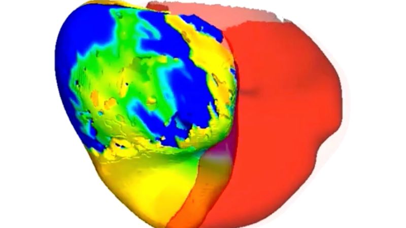 Scientists use digital twins of hearts to improve treatment for complex arrhythmias