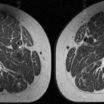 Ultraprocessed diets linked to alarming levels of intramuscular fat in older adults