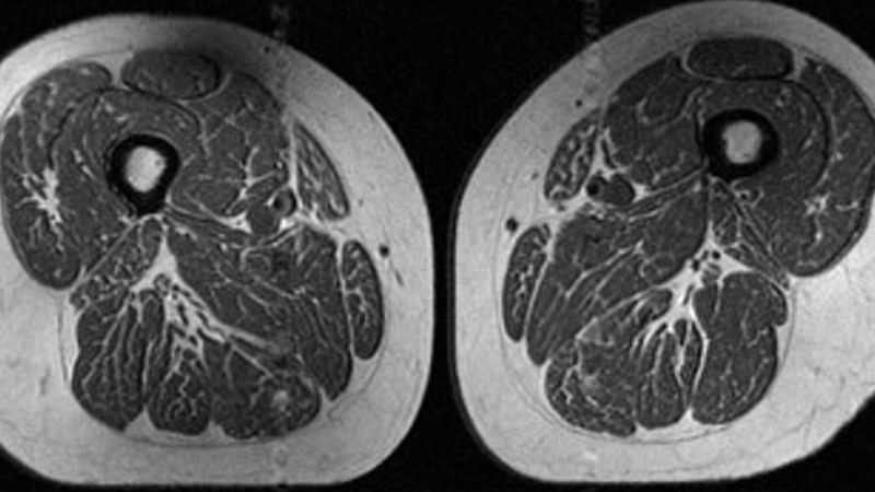 Ultraprocessed diets linked to alarming levels of intramuscular fat in older adults
