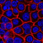 Experimental drug significantly improves survival in advanced pancreatic cancer patients