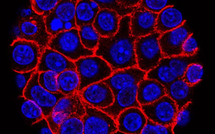 Experimental drug significantly improves survival in advanced pancreatic cancer patients