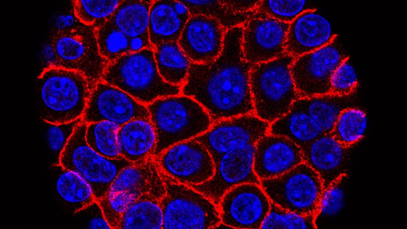 Experimental drug significantly improves survival in advanced pancreatic cancer patients