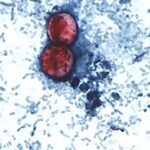 Cyclospora outbreak leads to over 3,000 diarrhea cases in Michigan and Ohio