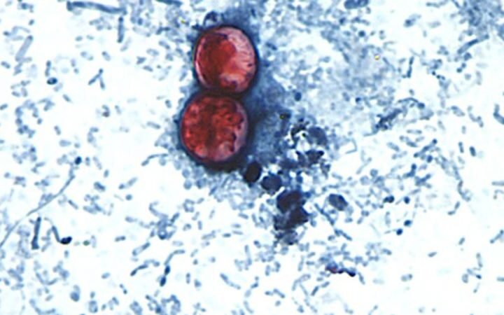Cyclospora outbreak leads to over 3,000 diarrhea cases in Michigan and Ohio