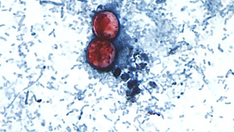 Cyclospora parasite outbreak linked to raw produce affects multiple US states