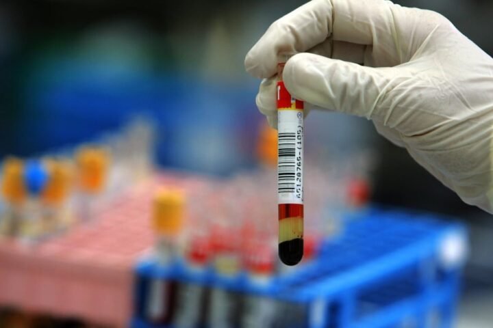 Simple cholesterol tests can help prevent heart attacks, experts advise