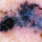 Moderna and Merck's personalized cancer vaccine shows promise in melanoma trial