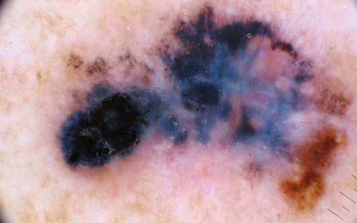 Moderna and Merck's personalized cancer vaccine shows promise in melanoma trial