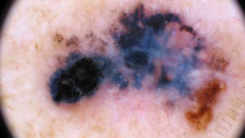 Moderna and Merck's personalized cancer vaccine shows promise in melanoma trial