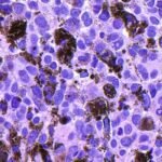 Moderna's melanoma vaccine demonstrates success in trial, boosting shares significantly