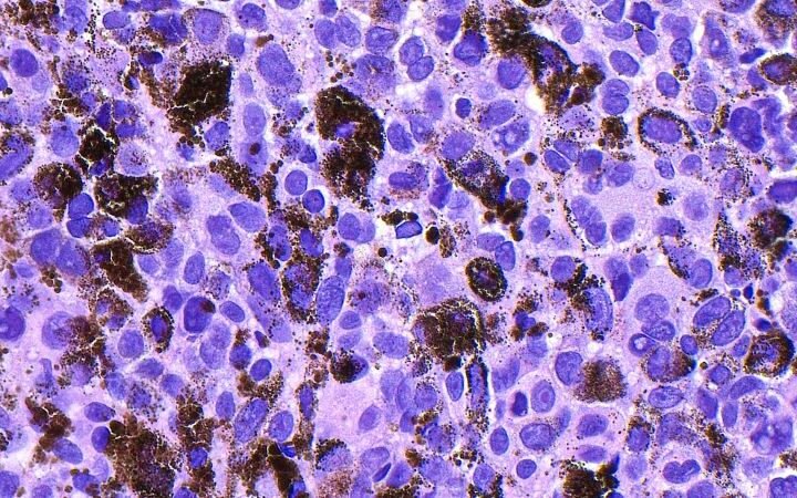 Moderna's melanoma vaccine demonstrates success in trial, boosting shares significantly