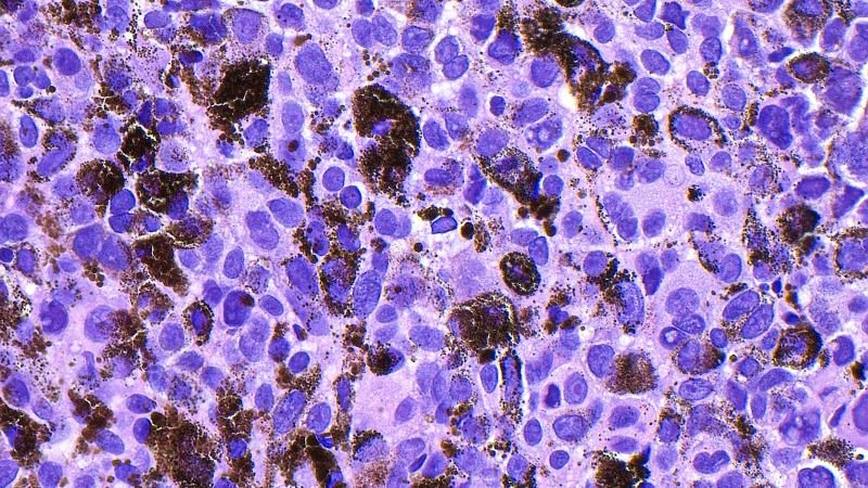 Moderna's melanoma vaccine demonstrates success in trial, boosting shares significantly