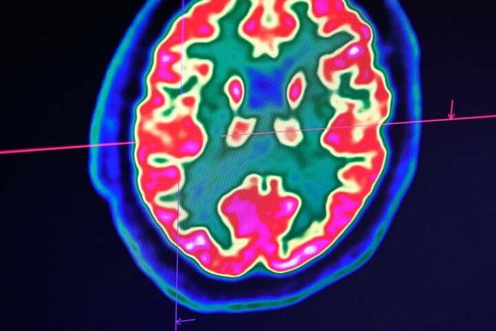 Scientists explore new brain drug Oveporexton as potential solution for fatigue and concentration issues