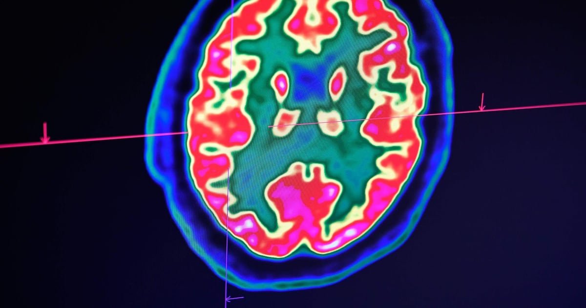 Scientists explore new brain drug Oveporexton as potential solution for fatigue and concentration issues