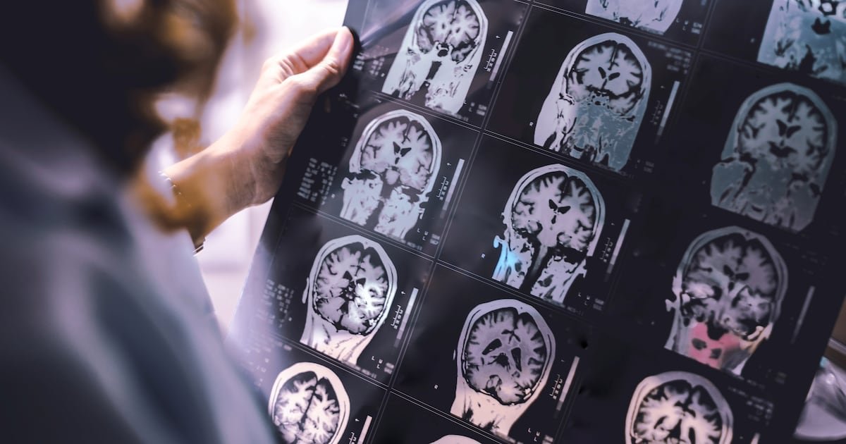 Study highlights key lifestyle changes to reduce dementia risk in middle age