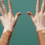 UAE becomes first country to approve new vitiligo treatment drug Rinvok