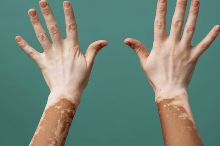 UAE becomes first country to approve new vitiligo treatment drug Rinvok