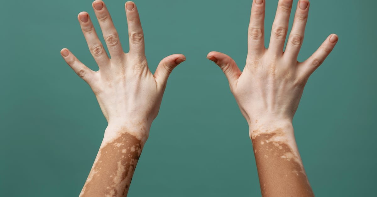 UAE becomes first country to approve new vitiligo treatment drug Rinvok