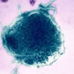 War of words erupts after two measles-related deaths reported in Pennsylvania