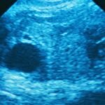 Ectopic pregnancy-related deaths rise sharply in states with abortion restrictions