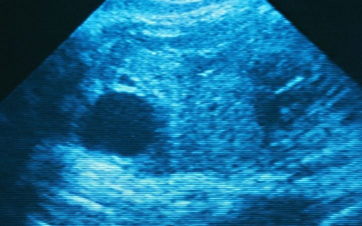 Ectopic pregnancy-related deaths rise sharply in states with abortion restrictions