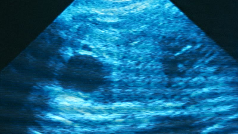 Ectopic pregnancy-related deaths rise sharply in states with abortion restrictions