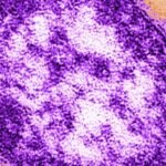 Fifth measles-related death reported in Pennsylvania as outbreak approaches a thousand cases