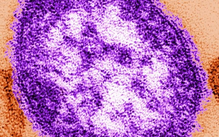 Fifth measles-related death reported in Pennsylvania as outbreak approaches a thousand cases