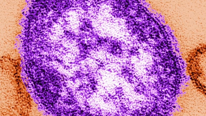 Fifth measles-related death reported in Pennsylvania as outbreak approaches a thousand cases