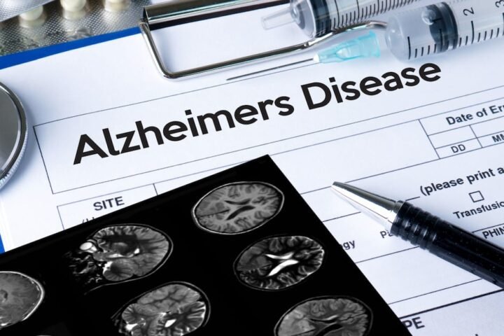 Major advances in dementia research spark optimism but challenges remain for treatment rollout