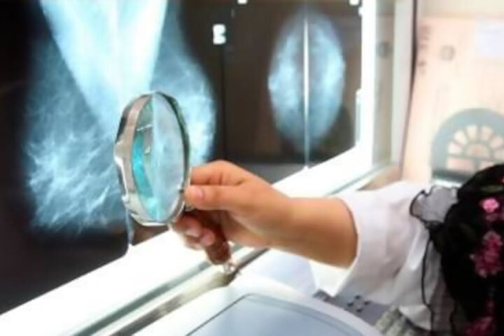 Type 2 diabetes linked to increased cancer risk, particularly among women, study finds