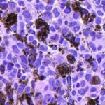Experimental mRNA vaccine shows 42% reduction in melanoma recurrence risk