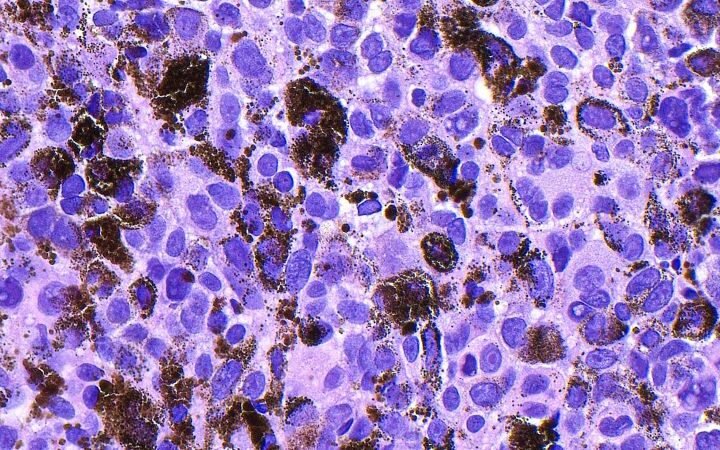 Experimental mRNA vaccine shows 42% reduction in melanoma recurrence risk