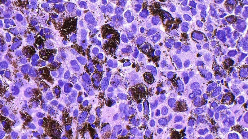 Experimental mRNA vaccine shows 42% reduction in melanoma recurrence risk