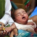 Experts warn Bangladesh's measles outbreak highlights urgent need for improved vaccination strategies