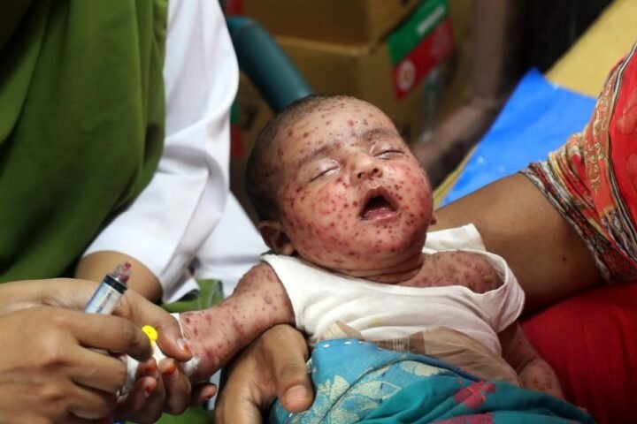 Experts warn Bangladesh's measles outbreak highlights urgent need for improved vaccination strategies