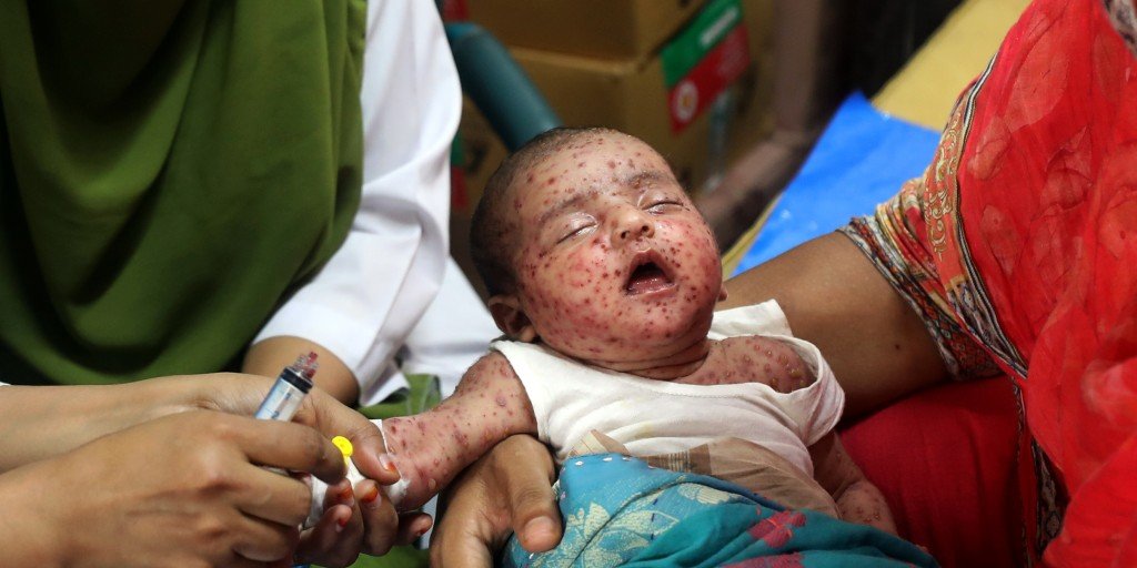 Experts warn Bangladesh's measles outbreak highlights urgent need for improved vaccination strategies