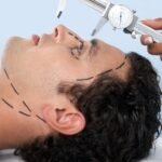 Weight-loss drugs disrupt cosmetic surgery market as demand for procedures declines
